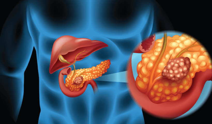 IIT Madras to develop biomarkers for early detection of pancreatic cancer